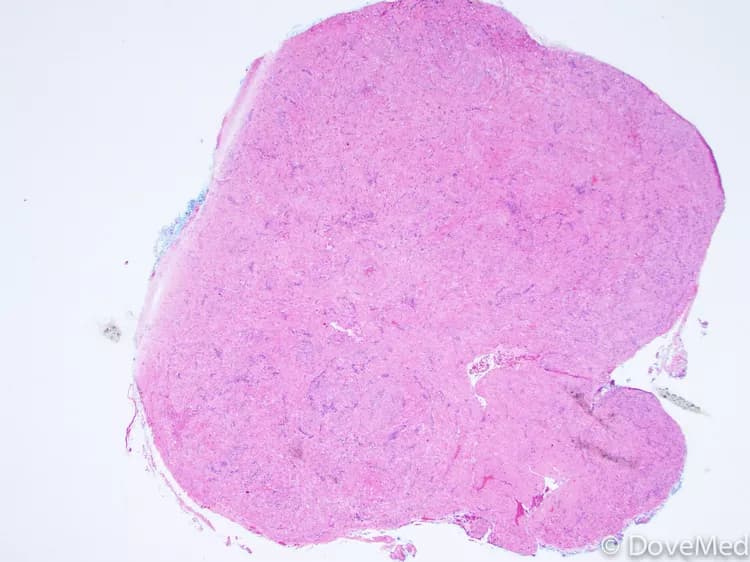 Leiomyoma of Vagina