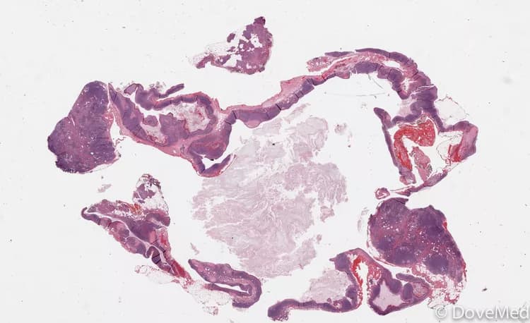 Lymphoepithelial Cyst of Pancreas