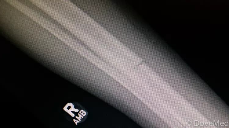 Fracture of the Tibia