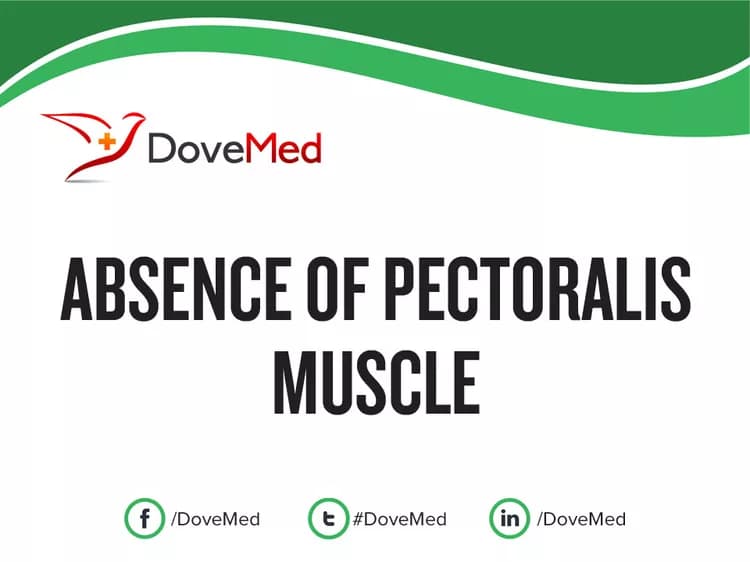 Absence of Pectoralis Muscle (due to Poland Syndrome)