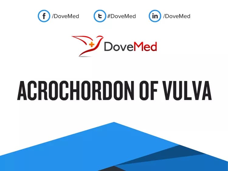 Acrochordon of Vulva