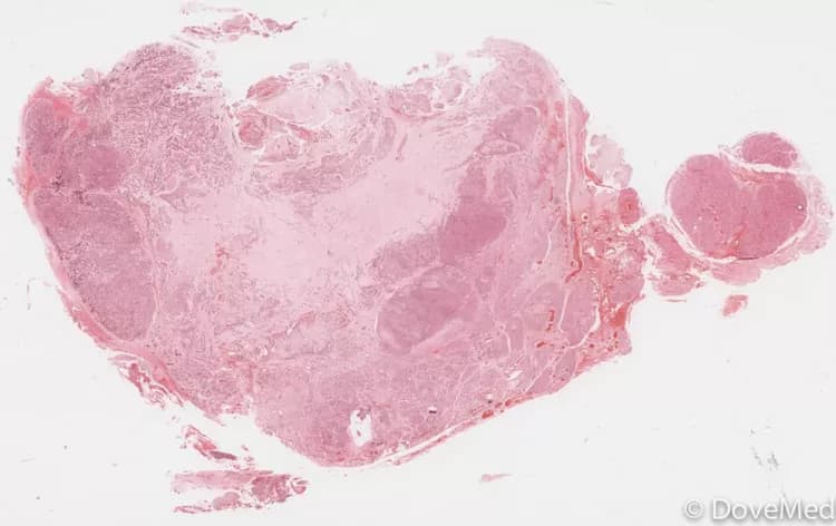 Adenoid Cystic Carcinoma of Esophagus
