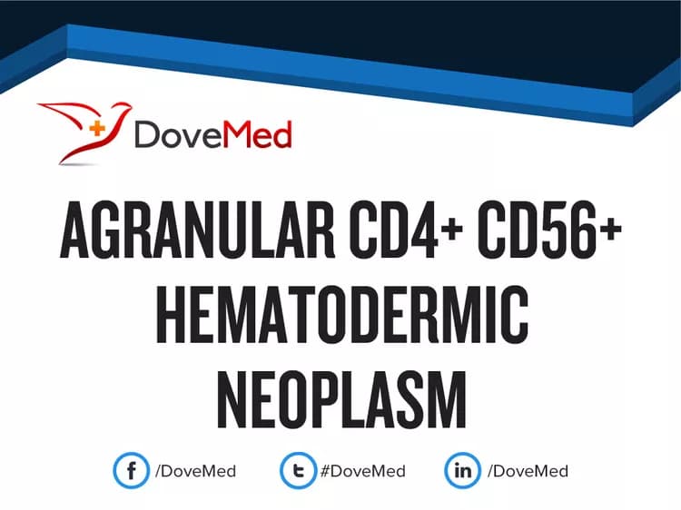 Agranular CD4+ CD56+ Hematodermic Neoplasm