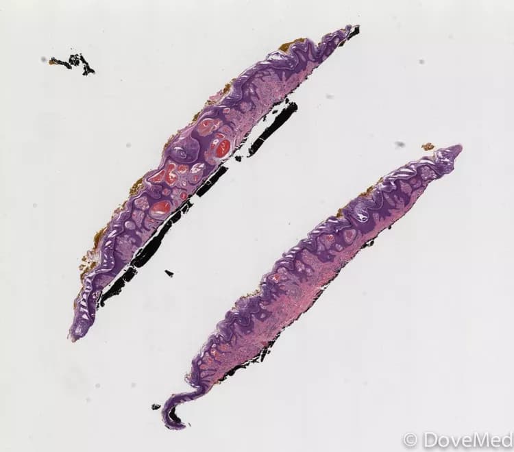 Angiokeratoma of Penis