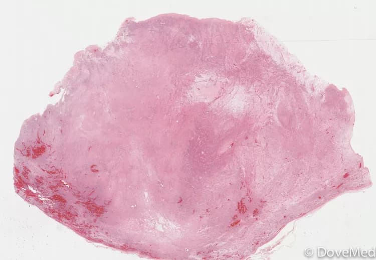Angiomyofibroblastoma of Scrotum