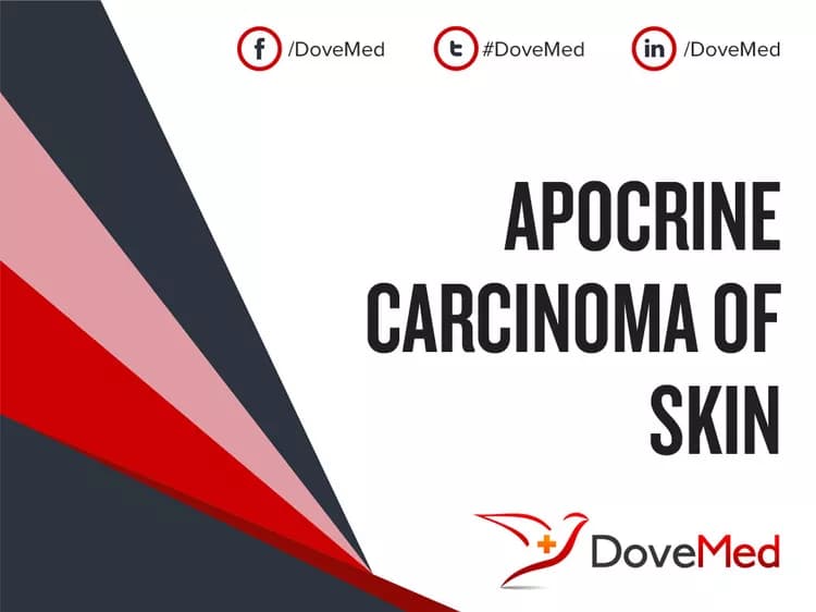 Apocrine Carcinoma of Skin