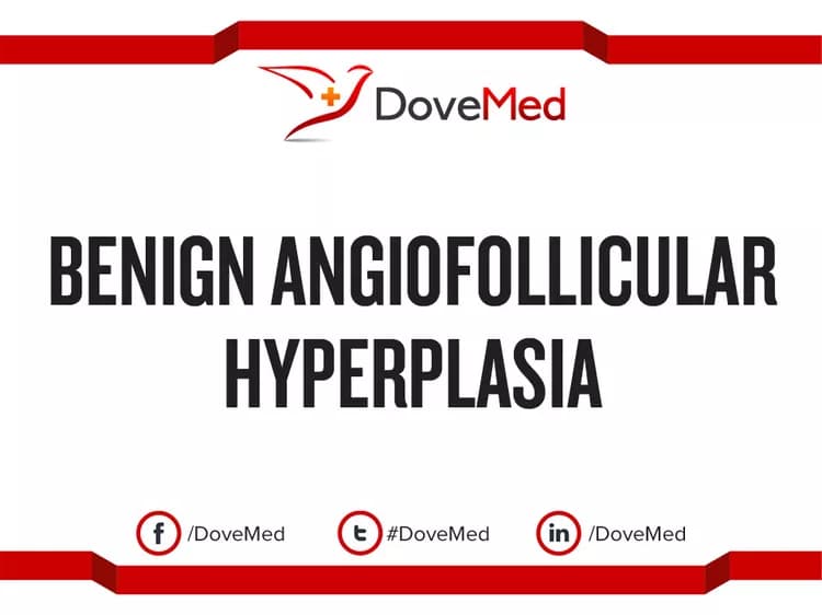 Benign Angiofollicular Hyperplasia