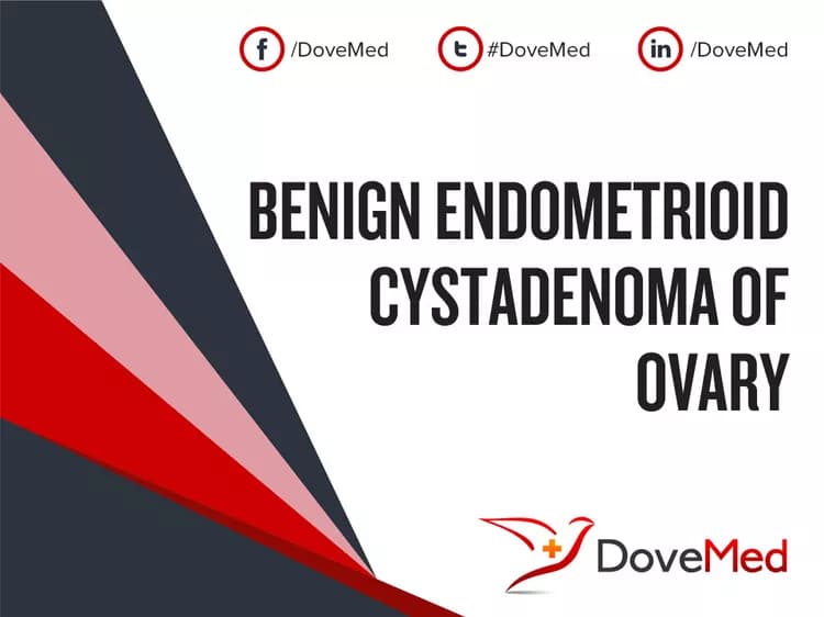 Benign Endometrioid Cystadenoma of Ovary