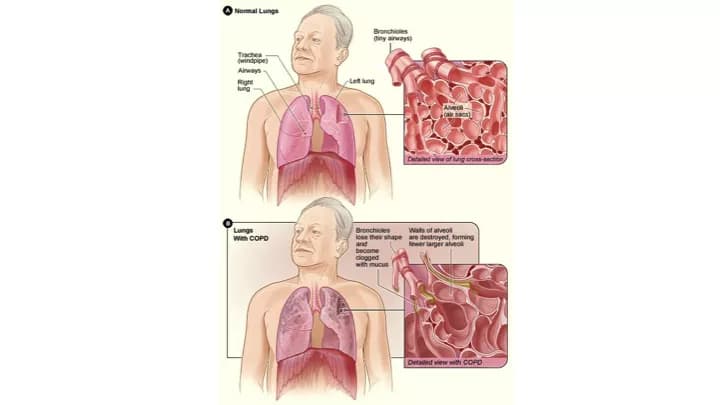 How well do you know Chronic Obstructive Pulmonary Disease (COPD)?