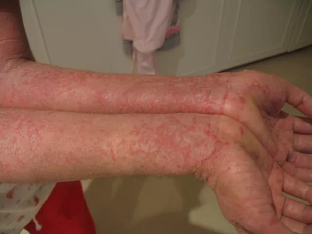 Eczema Linked To Reduced Cancer Risk?
