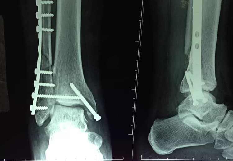 How well do you know Ankle Fracture?
