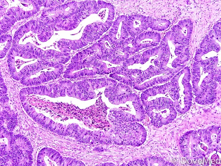 How well do you know Adenocarcinoma of Cervix?