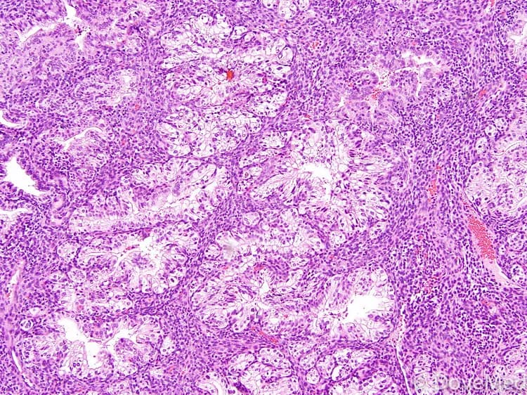 Clear Cell Carcinoma of Endometrium