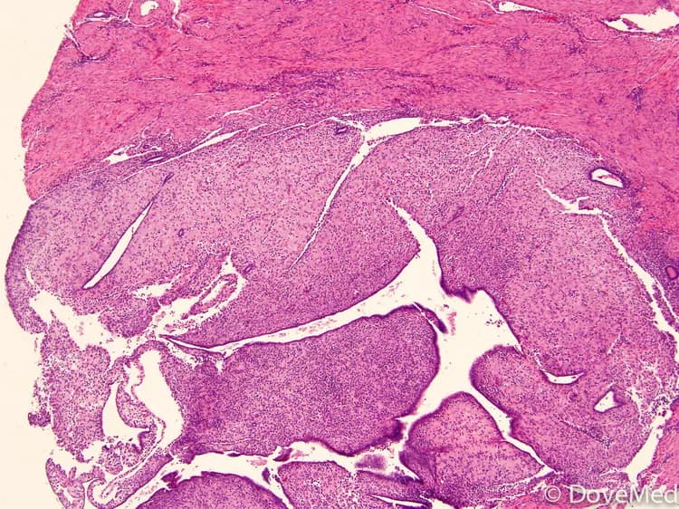 Adenomyoma of Uterine Cervix