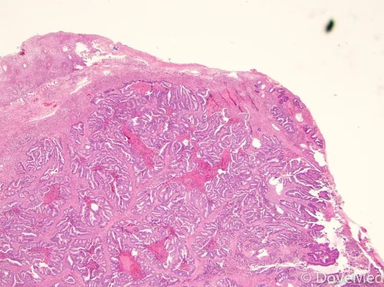 Adenocarcinoma of Cervix