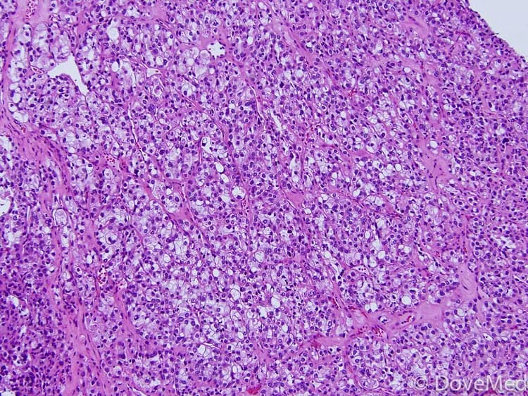 Clear Cell Carcinoma of Cervix