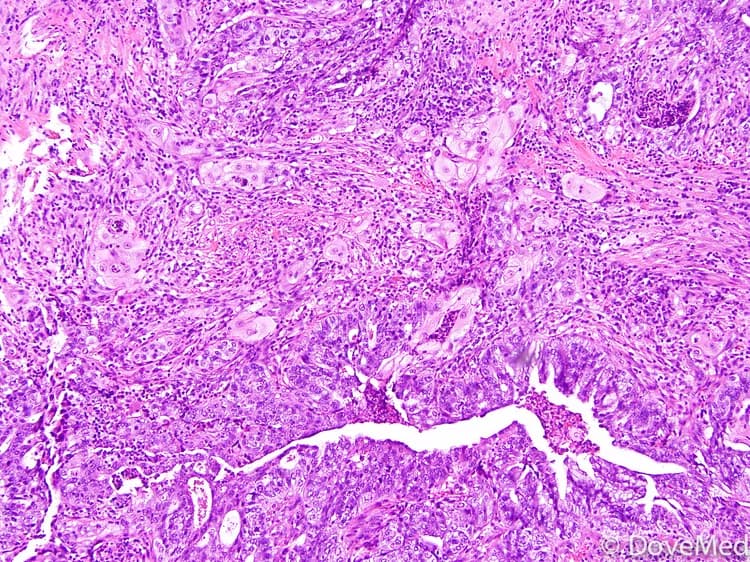 Adenosquamous Carcinoma of Uterine Cervix