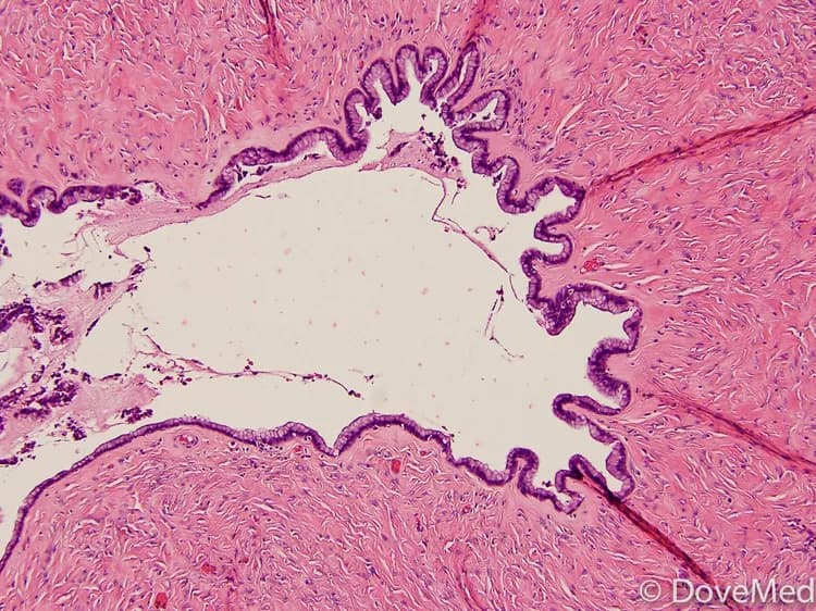 Benign Mucinous Cystadenoma of Pancreas