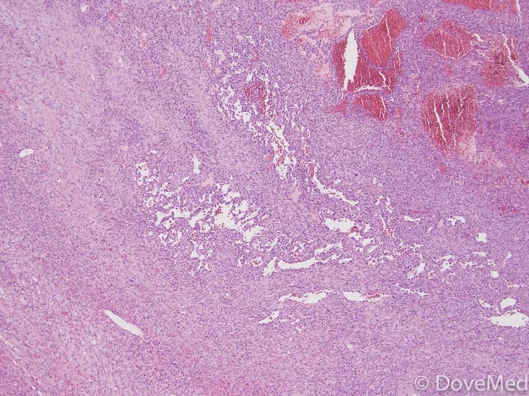Angiosarcoma of Salivary Gland