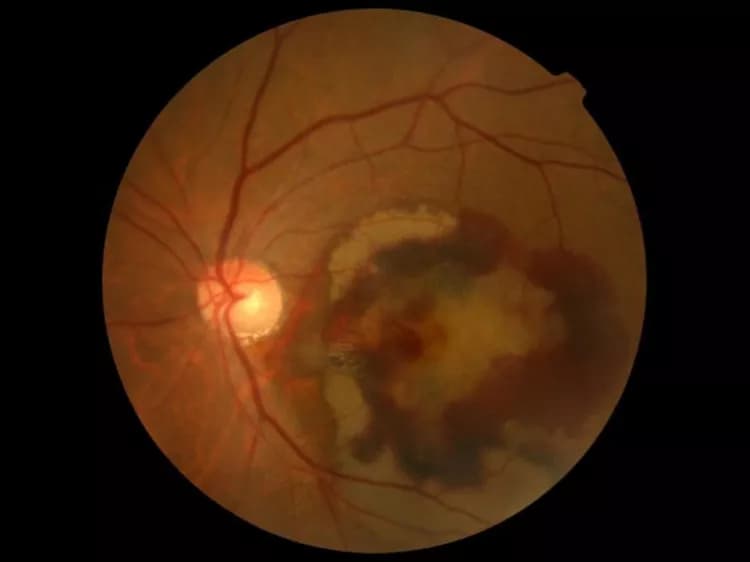 Reproducing A Retinal Disease On A Chip