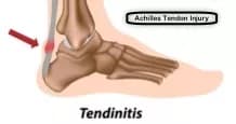 Facts about Achilles Tendinitis