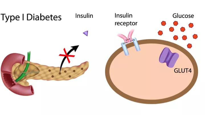 Scientists Solve Immune System Mystery For Type 1 Diabetes