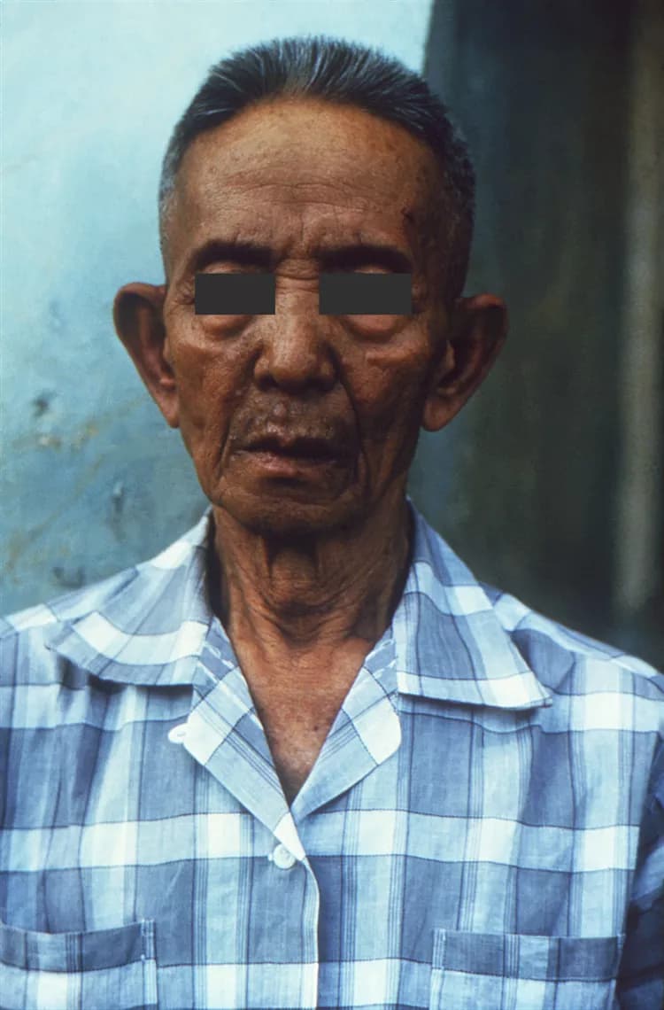 Facts about Leprosy