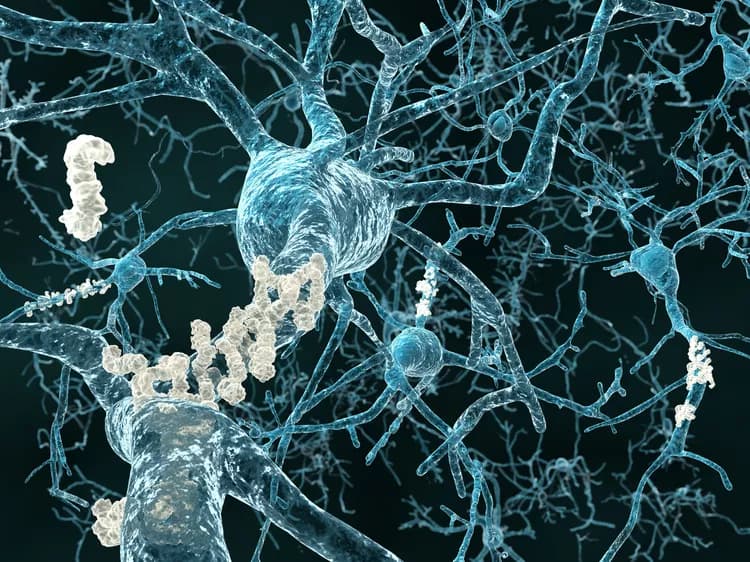 Impending Alzheimer’s Disease Apparent 18 Years Before Clinical Diagnosis