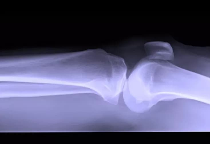 Researchers Use A Single Molecule To Command Stem Cells To Build New Bone
