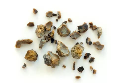 Facts about Urinary Bladder Stones