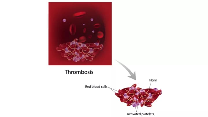 Physical Inactivity Increases Risk Of Thrombosis