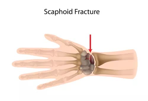 Facts about Scaphoid Fracture of the Wrist