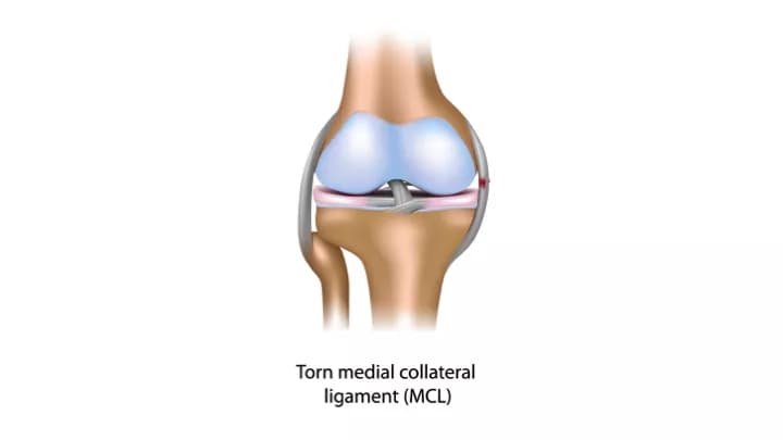 Medial Collateral Ligament (MCL) Injury