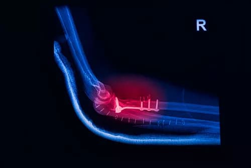 Facts about Radial Head Fracture