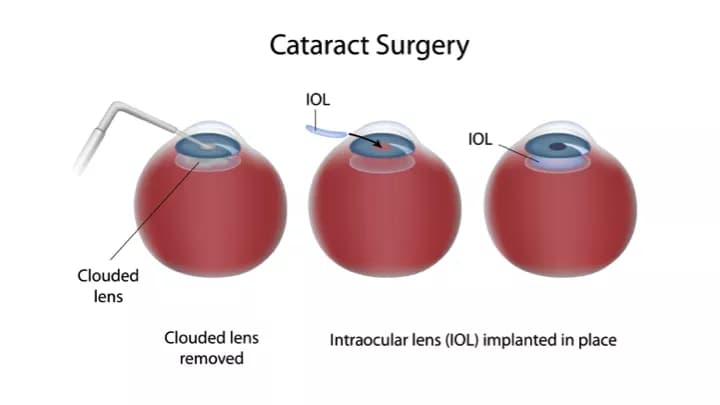 Cataract Extraction