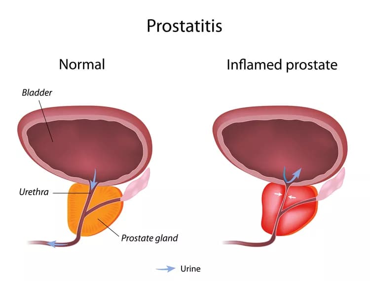 Chronic Prostate Inflammation Could Nearly Double The Risk Of Prostate Cancer