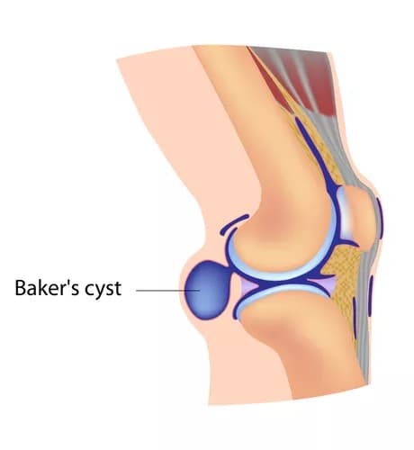 Baker’s Cyst
