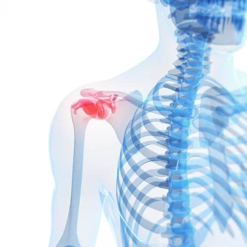 How well do you know Arthritis of the Shoulder