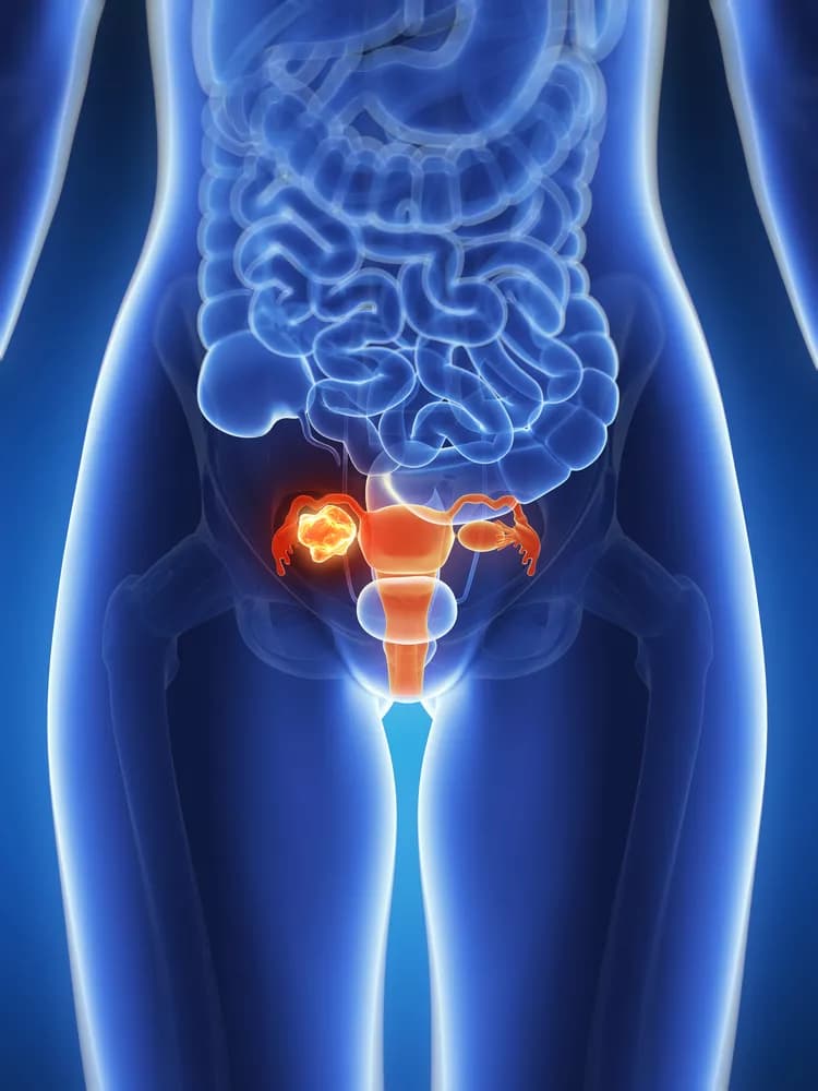 How well do you know Cervical Cancer?