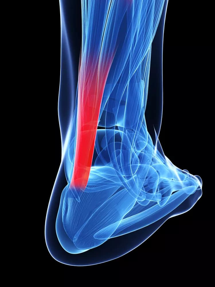 How well do you know Achilles Tendinitis?