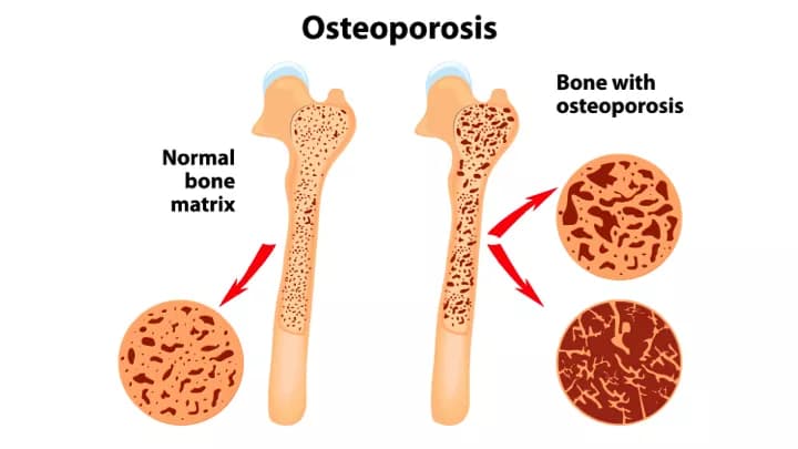 Osteoporosis - Primary (Type I)