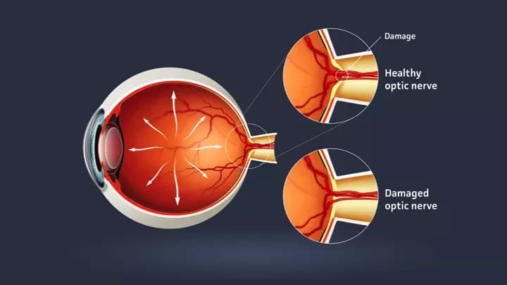 Facts about Glaucoma
