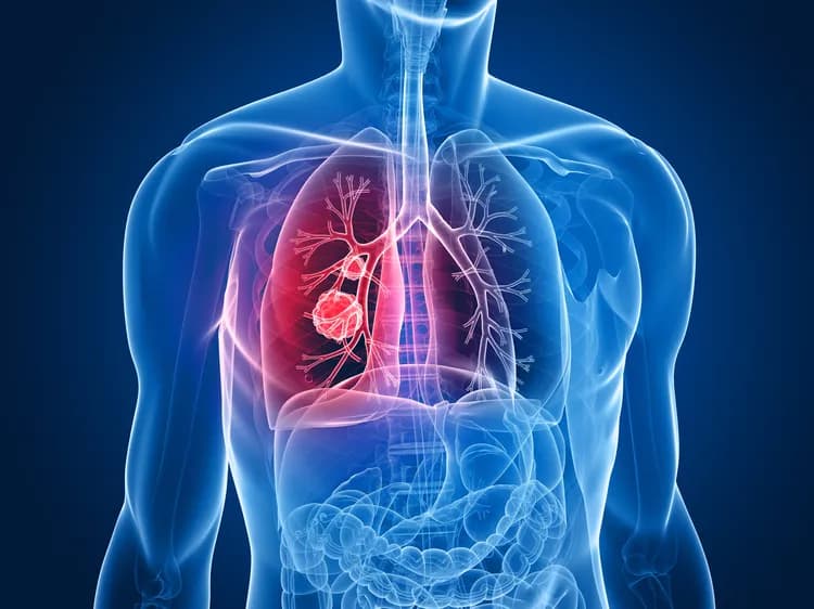 Anti-Inflammatory Therapy Cuts Risk Of Lung Cancer