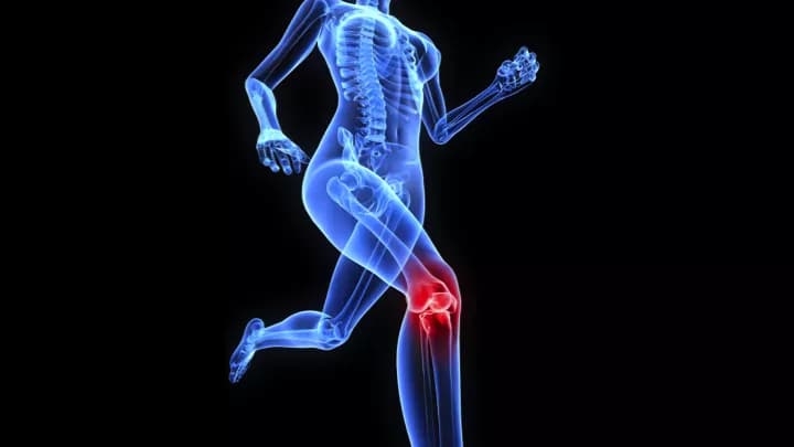 How well do you know Arthritis of the Knee?