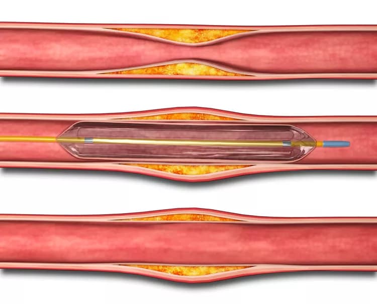 Angioplasty without Vascular Stenting