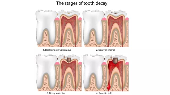Facts about Dental Cavities