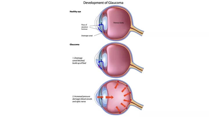 How well do you know Glaucoma