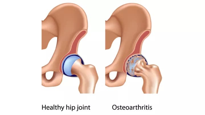 Facts about Osteoarthritis of the Hip