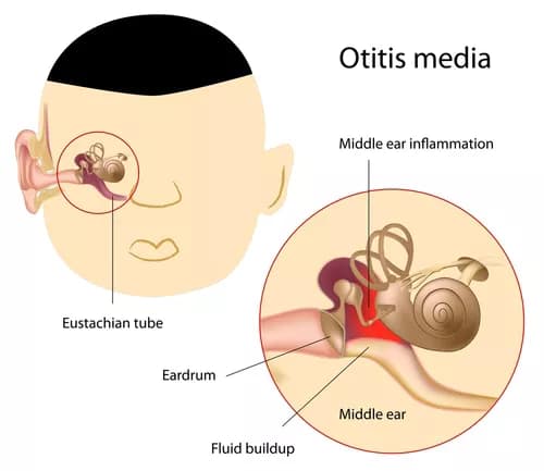 Facts about Acute Otitis Media