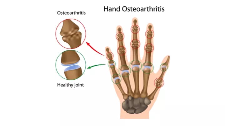How well do you know Arthritis of the Hand?